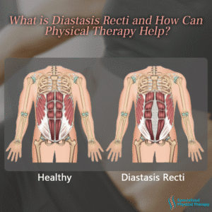 Diastasis Recti